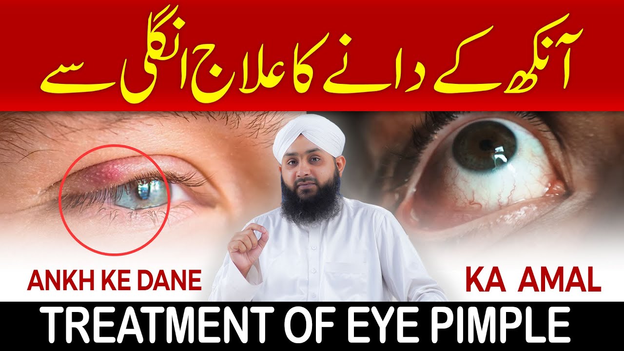 Ankh Ke Dane Ka Ilaj Ungli Se | Wazifa For Eye Problem | Ankh Main Dane Ka Hal | (ENG SUB)